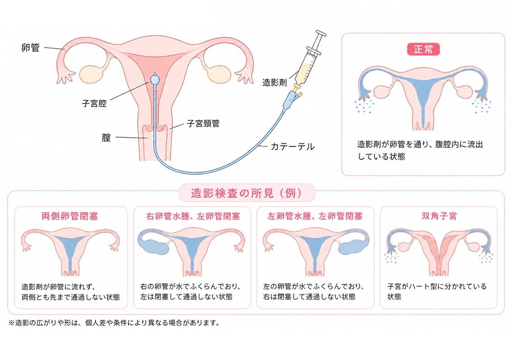 子宮卵管造影検査